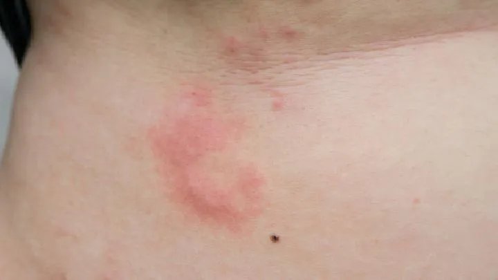 中医治疗荨麻疹如何