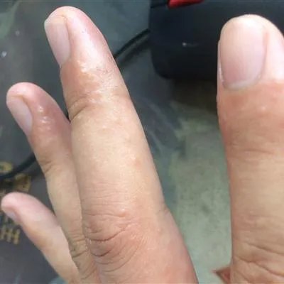 风疹病毒阳性怎么治疗