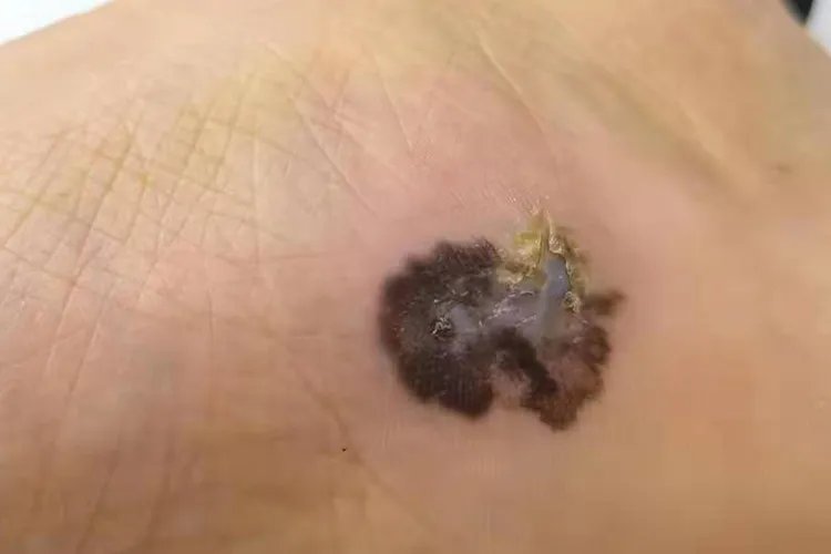 黑色素瘤早期症状图片
