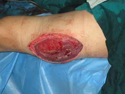 气性坏疽症状图片