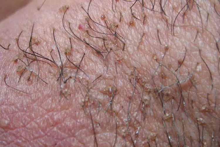 女性阴虱的症状图片