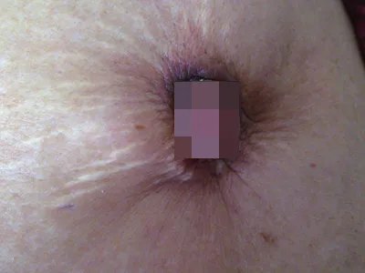 乳腺癌症状图片