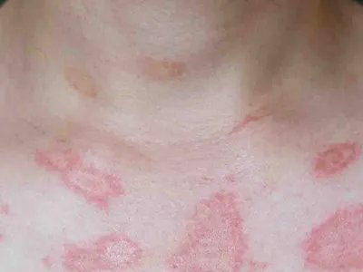 盘状红斑狼疮红斑图片