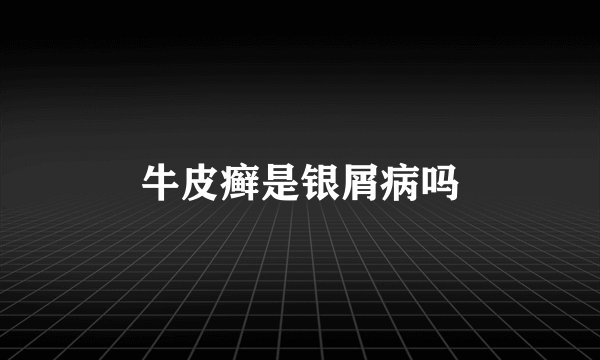 牛皮癣是银屑病吗