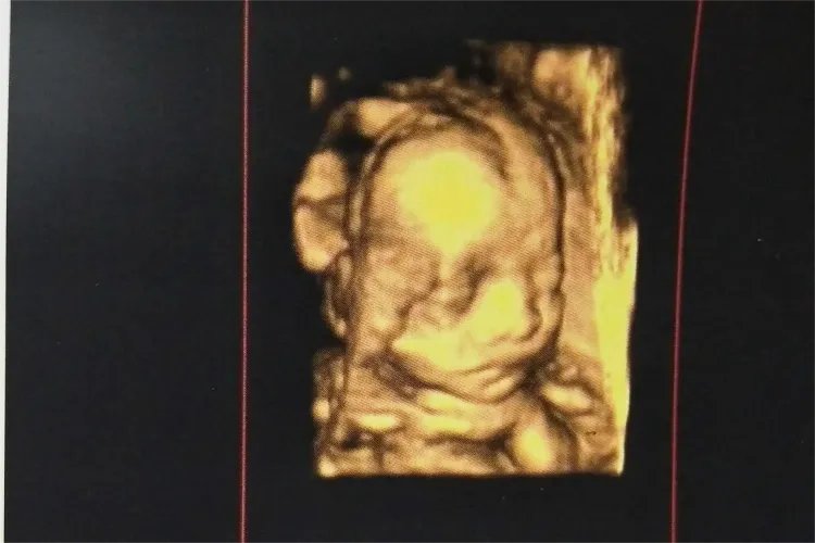 怀孕五个月胎儿B超图