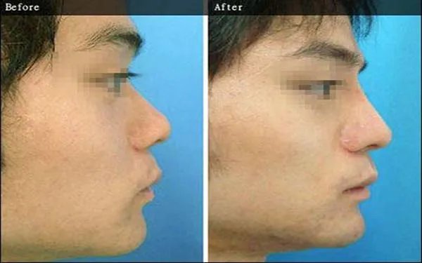 天津整形医院哪家做隆鼻好