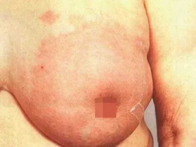 乳腺癌症状图片