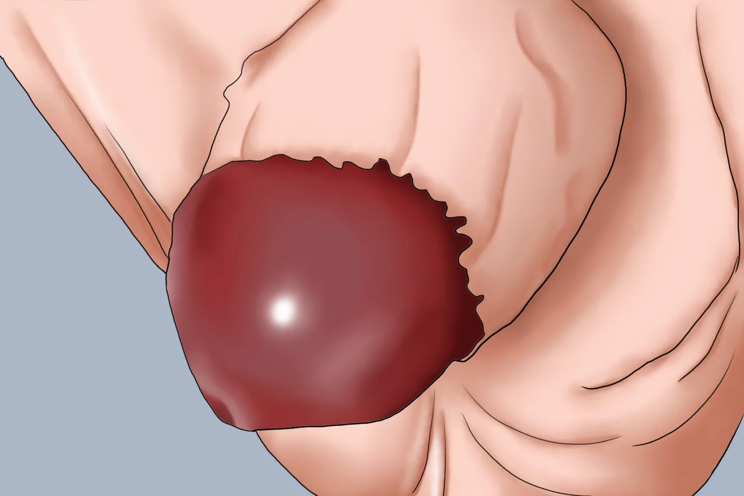 儿童包皮手术后水肿图片