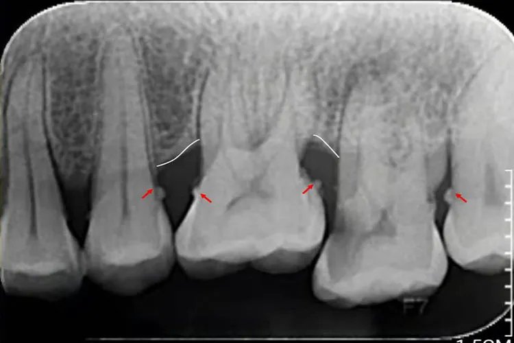 牙结石是什么样的图片危害