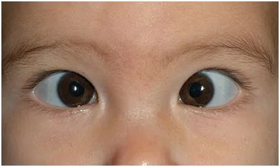 六个月宝宝斗鸡眼图片