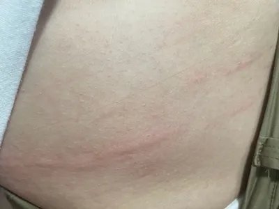 人工荨麻疹症状图片