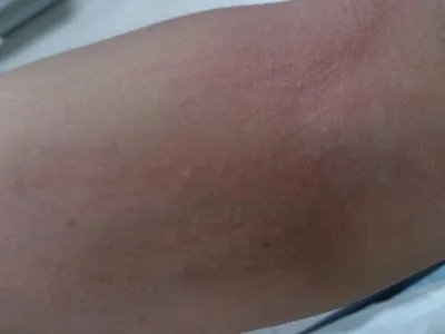 皮肤过敏红肿胳膊症状图片