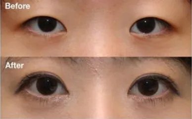 韩式翘睫双眼皮优点