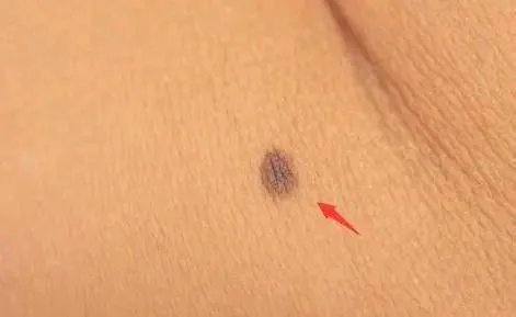 去一颗痣大概要多少钱