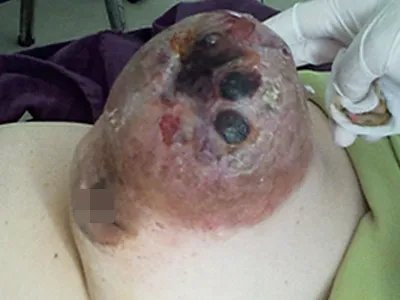 乳腺癌症状图片