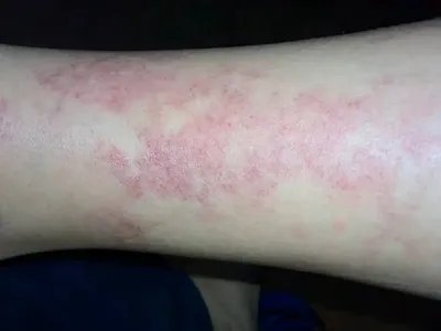 皮肤过敏红肿胳膊症状图片