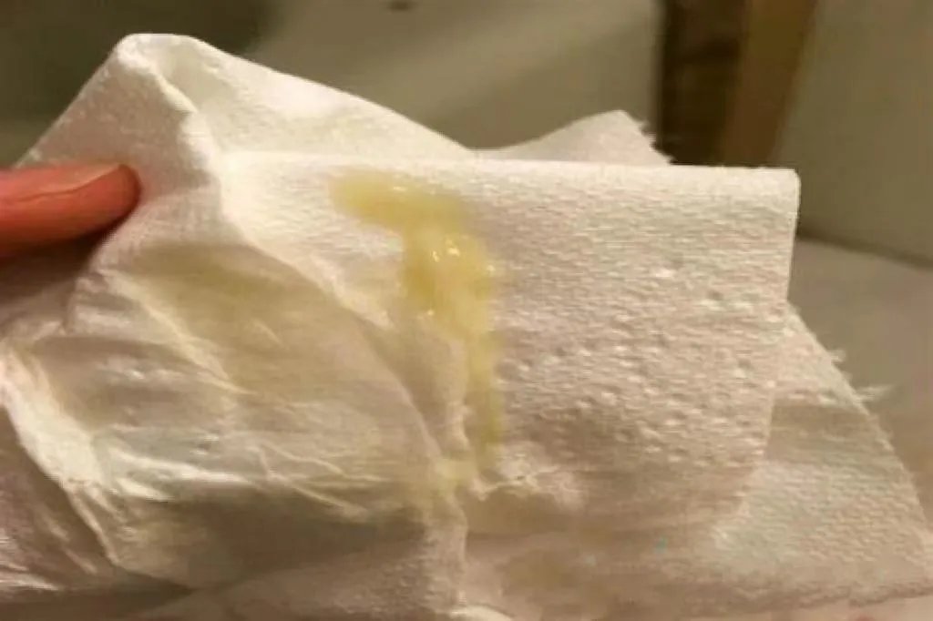 宫颈癌血性白带图片