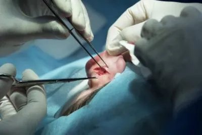 良性脑瘤手术需要多少钱