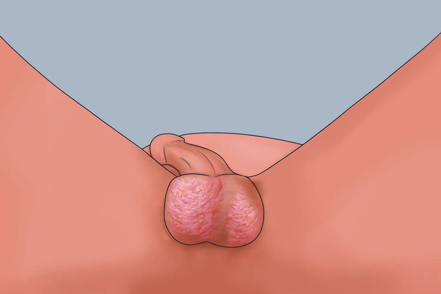 阴囊湿疹阴囊症状图片