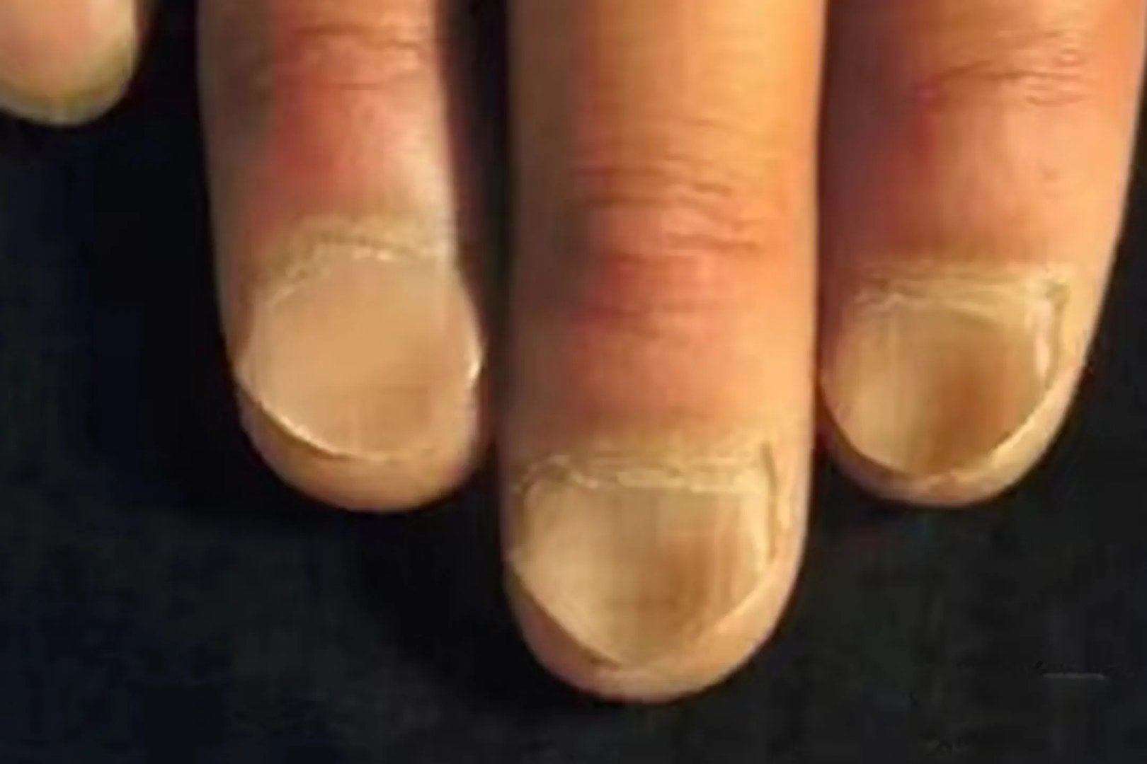 贫血严重会出现什么样的症状