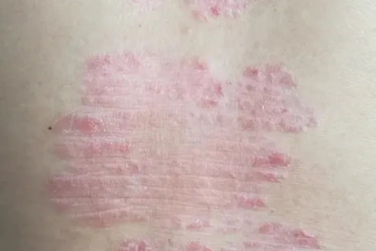 点滴状银屑病三个阶段图片