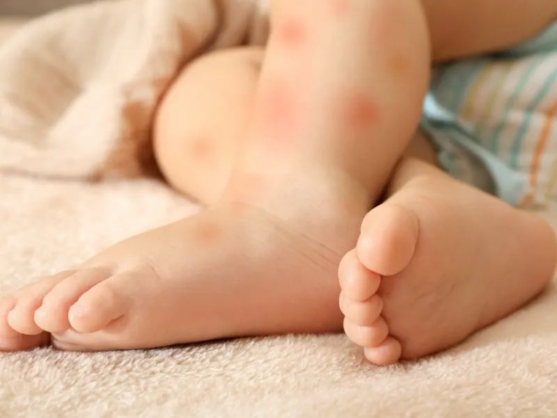 小儿皮肤过敏怎么办