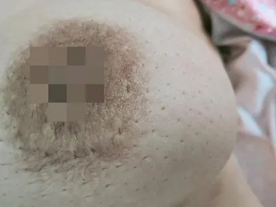 乳腺癌症状图片