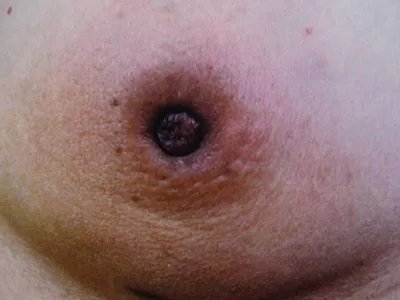 乳腺癌症状图片