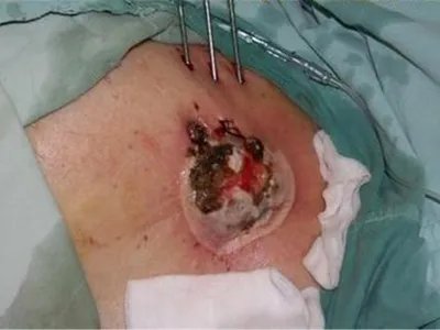 乳腺癌症状图片