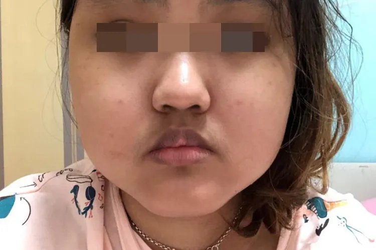 激素水牛背满月脸图片