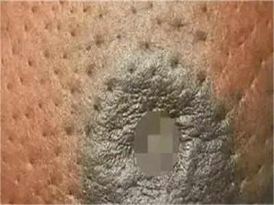 乳腺癌症状图片