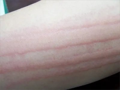 人工荨麻疹症状图片