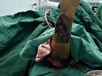 气性坏疽症状图片