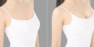 脂肪移植隆胸适合人群