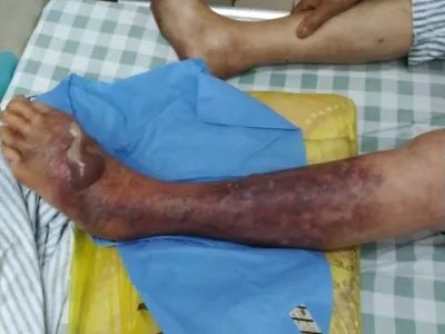 气性坏疽症状图片