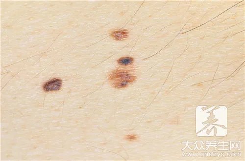  痣在脸上的位置所代表的意义