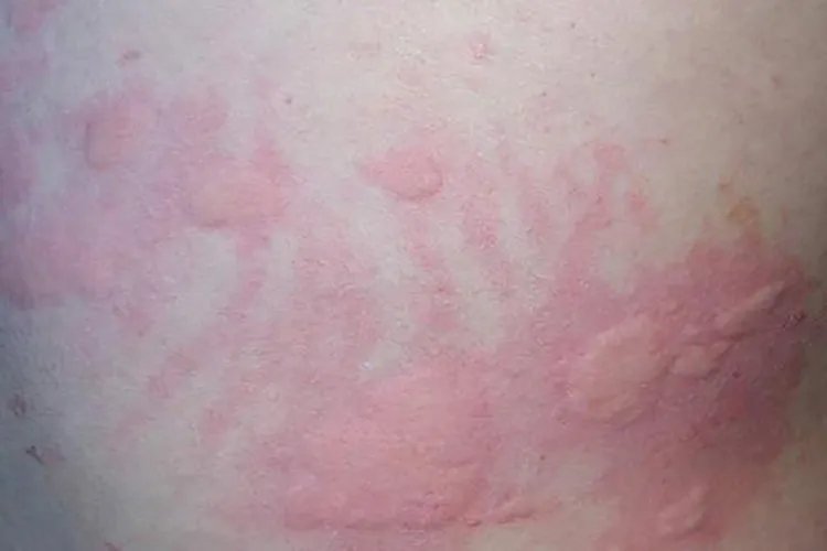 荨麻疹图片和症状图