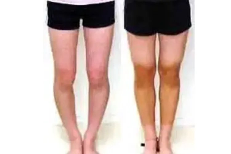 罗圈腿和正常腿图片