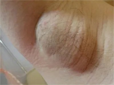 乳腺癌症状图片