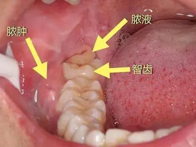 智齿冠周炎牙龈症状图片