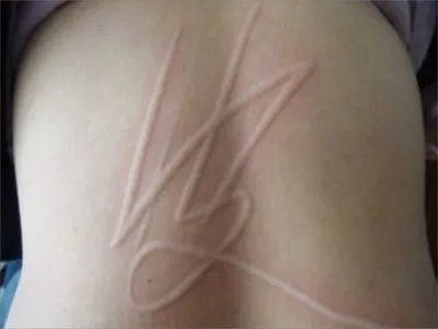 人工荨麻疹症状图片