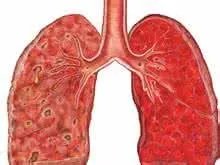 肺癌原发肿瘤的症状体征