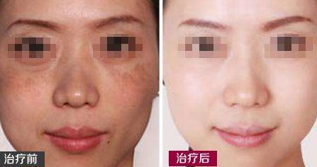 北京像束激光美白嫩肤效果怎么样