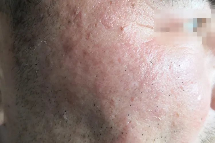 轻微的丹毒图片