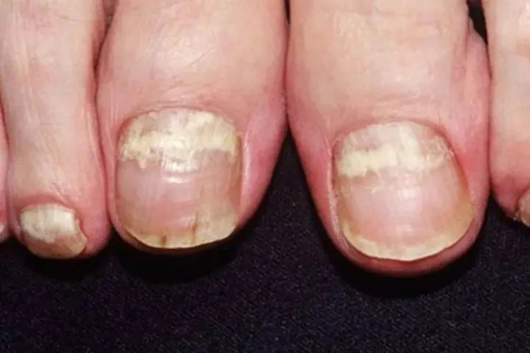 灰指甲图片全图