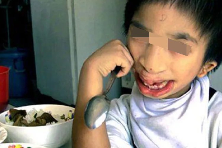 儿童巨人症图片