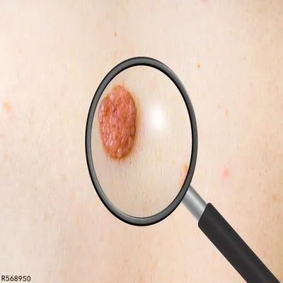 色素痣和色素瘤有何区别