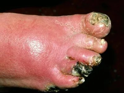 气性坏疽症状图片