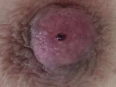 乳腺癌症状图片