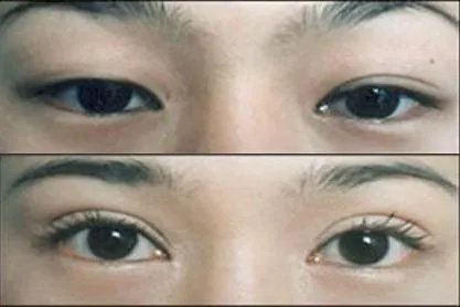 埋线双眼皮肉条图片